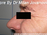 Before Botox