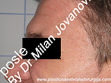 After Botox