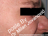 After Botox