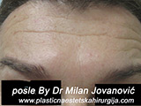 After Botox