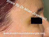 After Botox