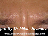 Before Botox