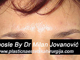 After Botox