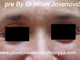 Before Botox