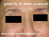 After Botox