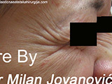 Before Botox