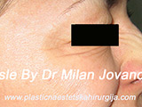 After Botox