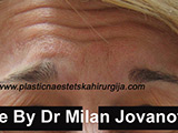 Before Botox