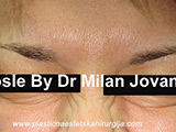 After Botox