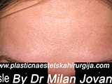 After Botox