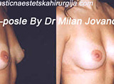 Before and after breast augmentation