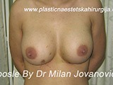 After breast augmentation