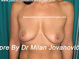 Before breast augmentation