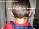 After ear surgery After ear surgery