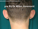 Before ear surgery Before ear surgery
