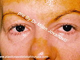 Before eyelid surgery Before eyelid surgery
