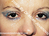 After eyelid surgery After eyelid surgery