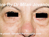 Before eyelid surgery Before eyelid surgery