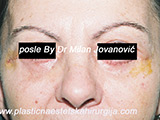 After eyelid surgery After eyelid surgery