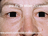 Before eyelid surgery Before eyelid surgery