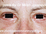 After eyelid surgery After eyelid surgery