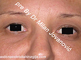 Before eyelid surgery Before eyelid surgery