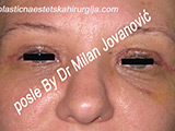 After eyelid surgery After eyelid surgery