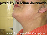 After face lift