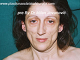 Result before facial fat grafting