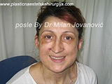 Result after facial fat grafting