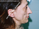 Result before facial fat grafting