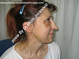Result after facial fat grafting
