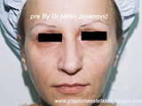 Result before facial fat grafting