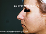 Result before facial fat grafting