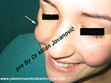 Result before facial fat grafting