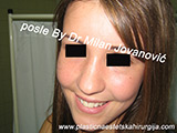 Result after facial fat grafting