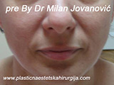 Before Face fillers