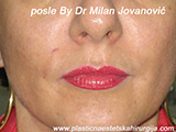 After Face fillers