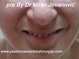 Before Face fillers