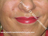 After Face fillers