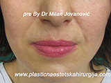 Before Face fillers