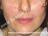 After Face fillers