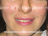 After Face fillers