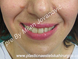 Before Face fillers