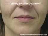 Before Face fillers