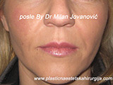 After Face fillers