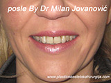 After Face fillers