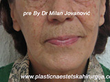 Before Face fillers