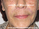 After Face fillers