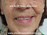 Before Face fillers